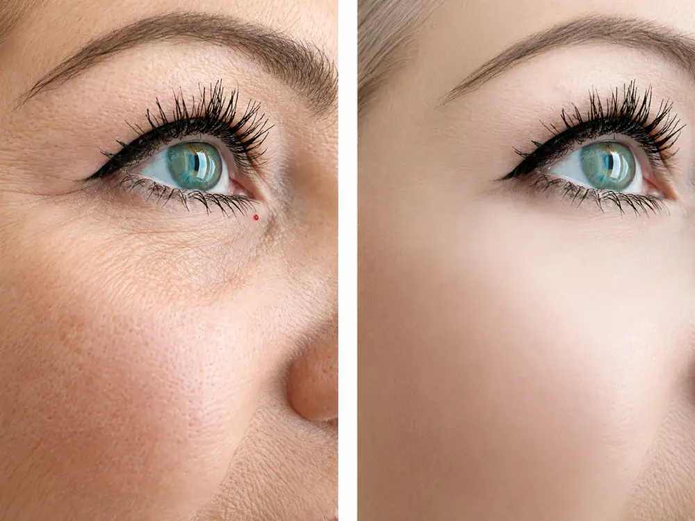 Blepharoplasty (Eyelid Surgery)