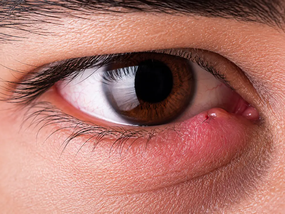 Eyelid Lumps and Bumps