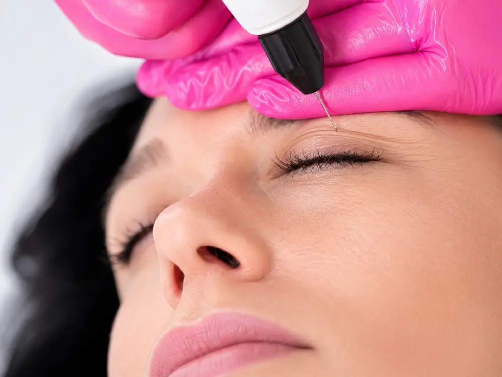 Xanthelasma